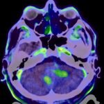 Radiofármacos innovadores permiten diagnósticos más precisos en neuro-oncología y Parkinson.