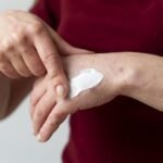 Quemaduras en diciembre: experta explica cómo tratar adecuadamente heridas leves y graves